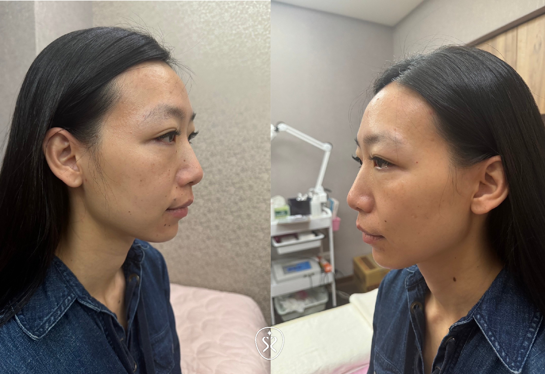 十蓓電波的核心技術是利用單極電波能量，採用容積式大面積加熱，熱能堆積更全面外，將熱量安全而深入地傳遞至真皮層，帶來緊緻的效果